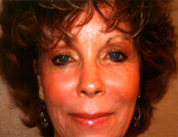 Procedure before and after - after