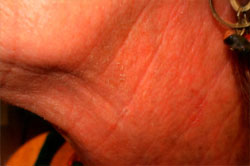 Procedure before and after - after