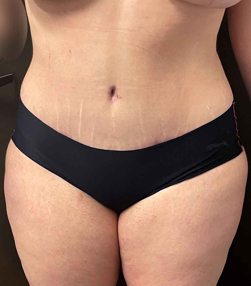 Tummy Tuck before and after - after