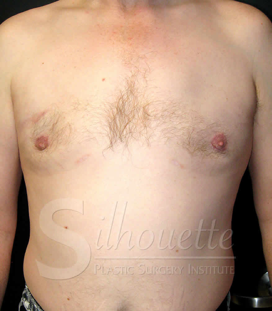 Procedure before and after - after