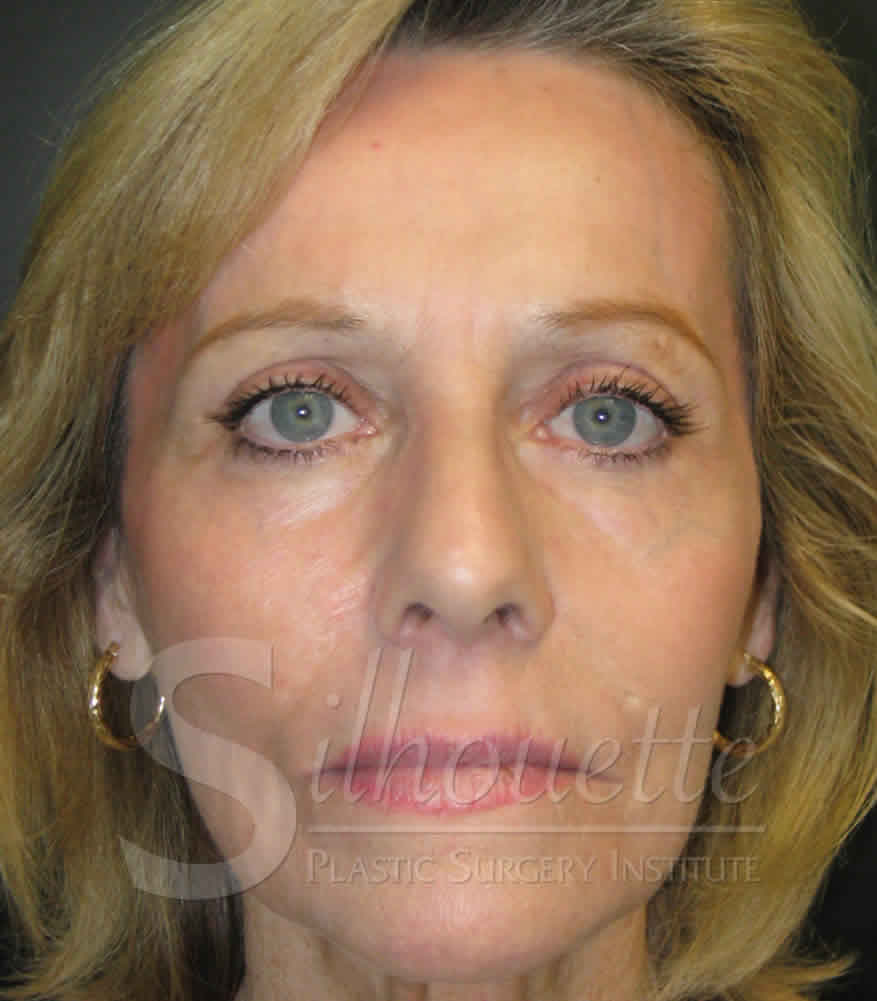 Procedure before and after - after