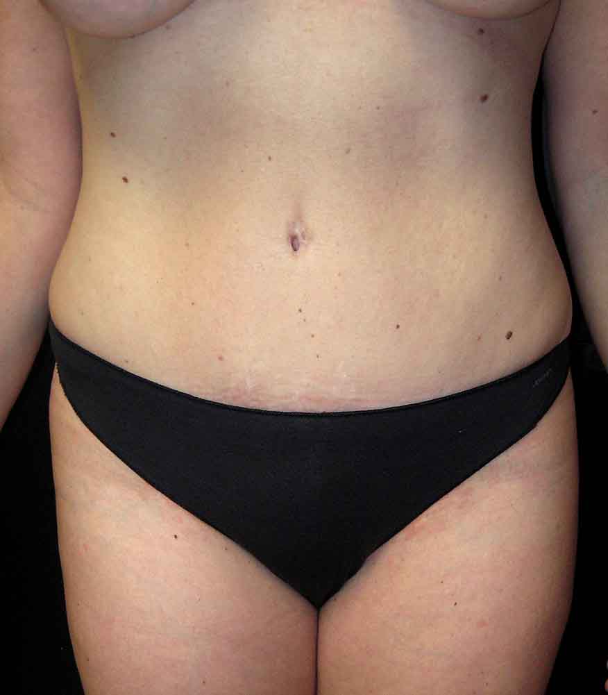 Tummy Tuck before and after - after