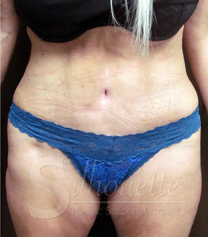 Tummy Tuck before and after - after