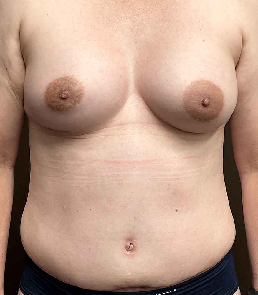 Breast Augmentation before and after - after