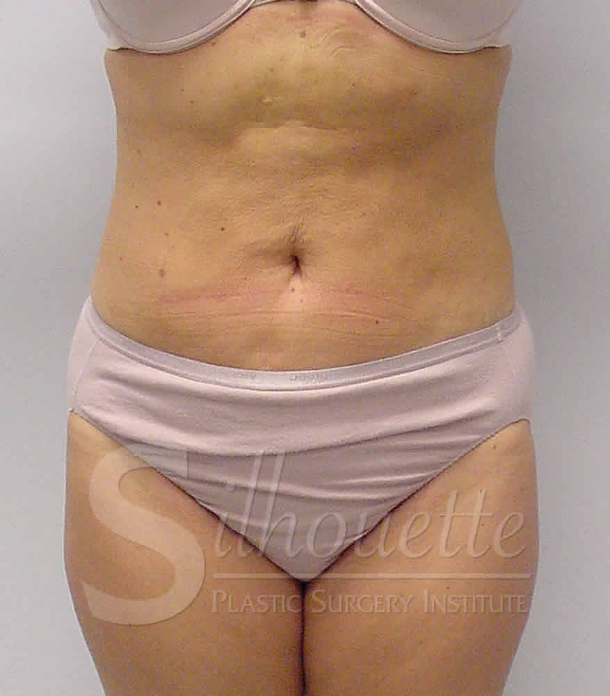 Liposuction before and after - after