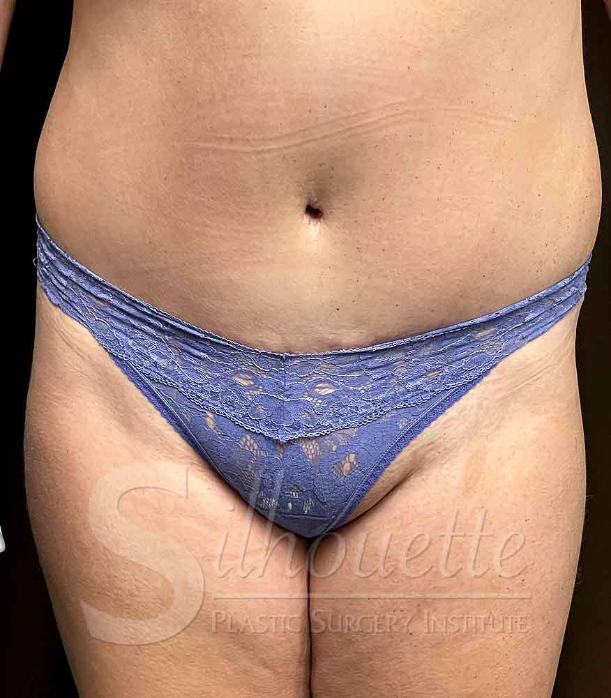 Tummy Tuck before and after - after