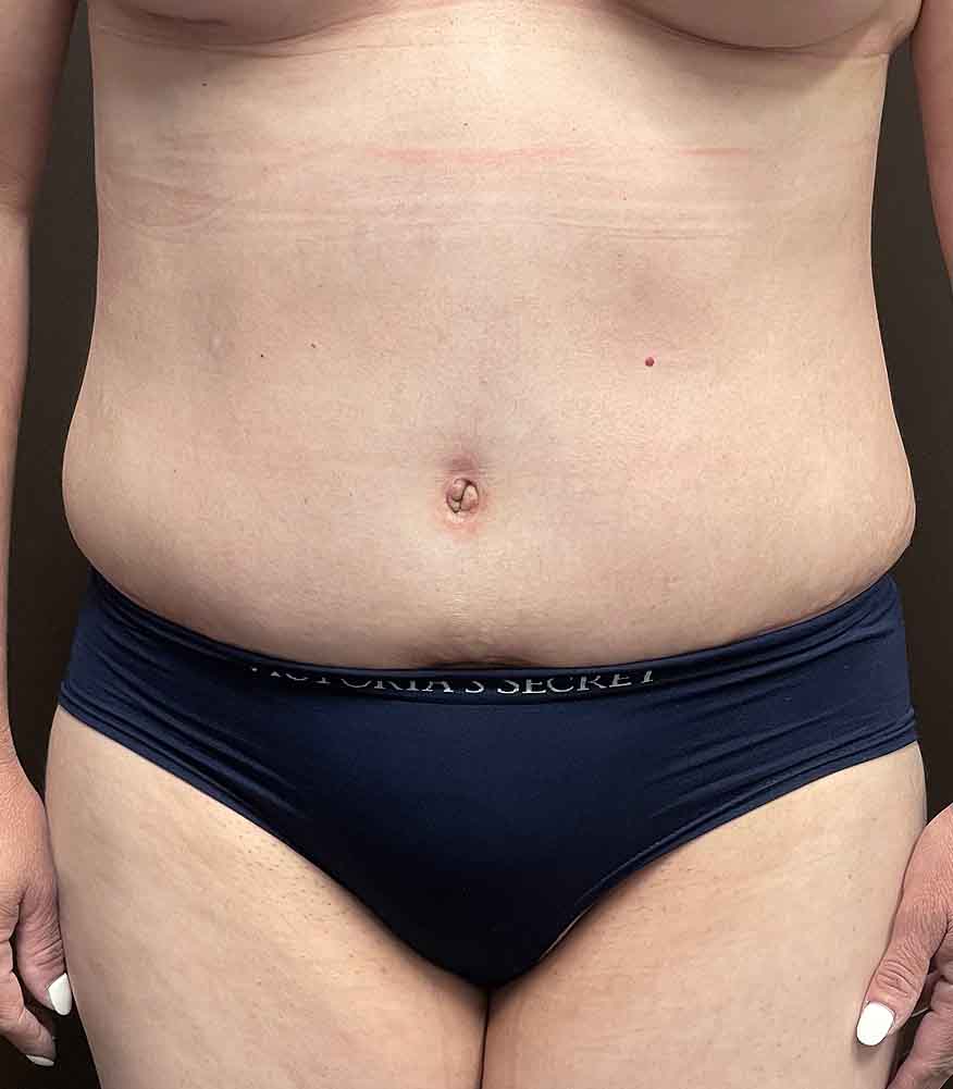 Tummy Tuck before and after - after