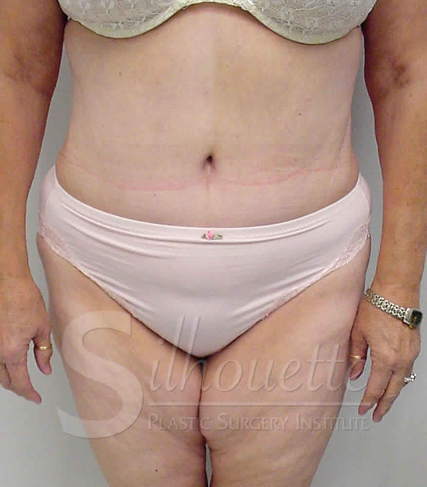 Procedure before and after - after