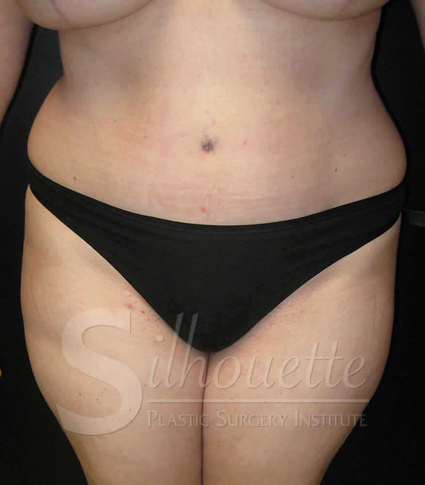Procedure before and after - after