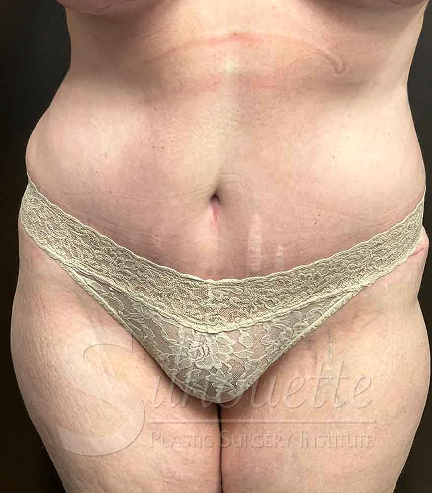 Tummy Tuck before and after - after