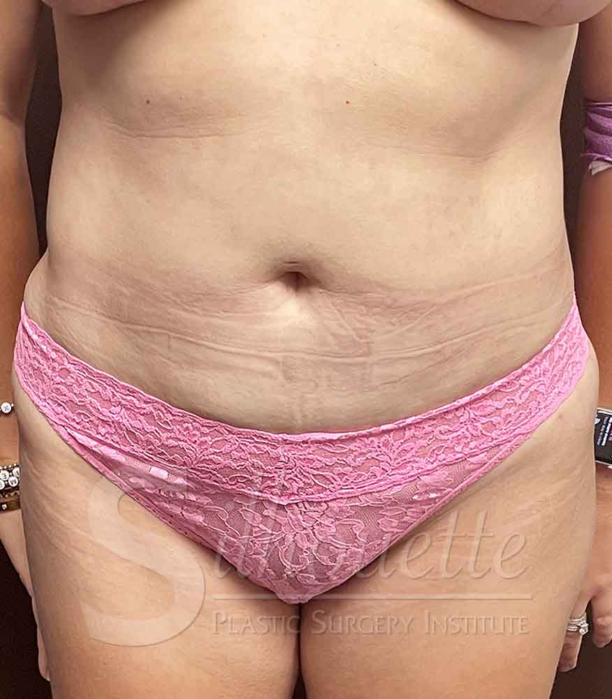Tummy Tuck before and after - after