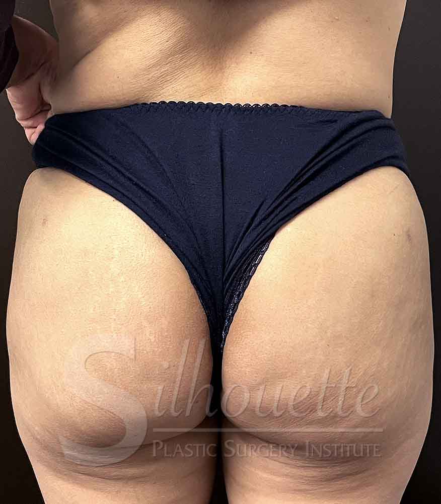 Procedure before and after - after