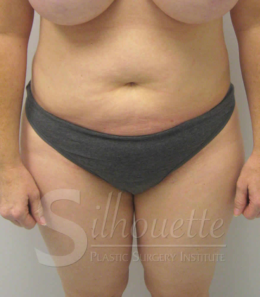Liposuction before and after - after