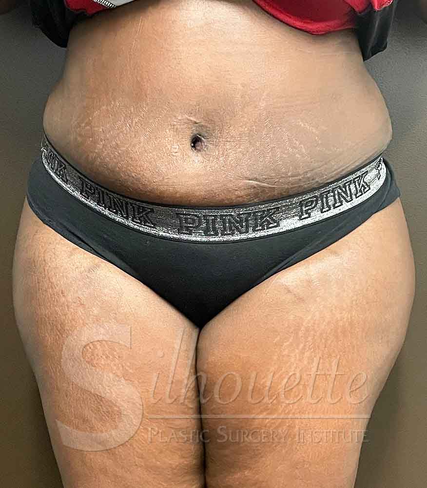 Tummy Tuck before and after - after