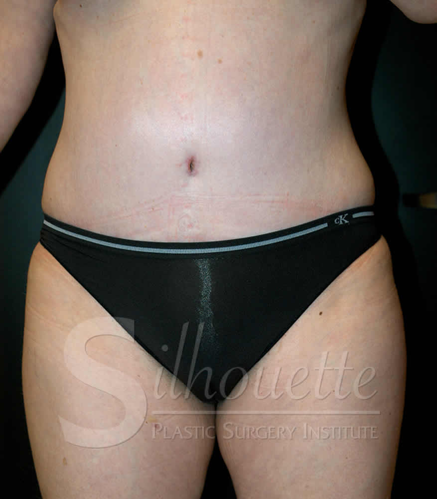 Liposuction before and after - after