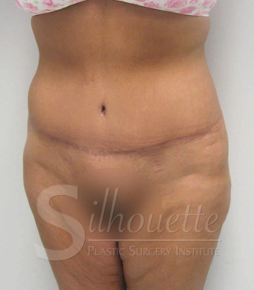 Procedure before and after - after