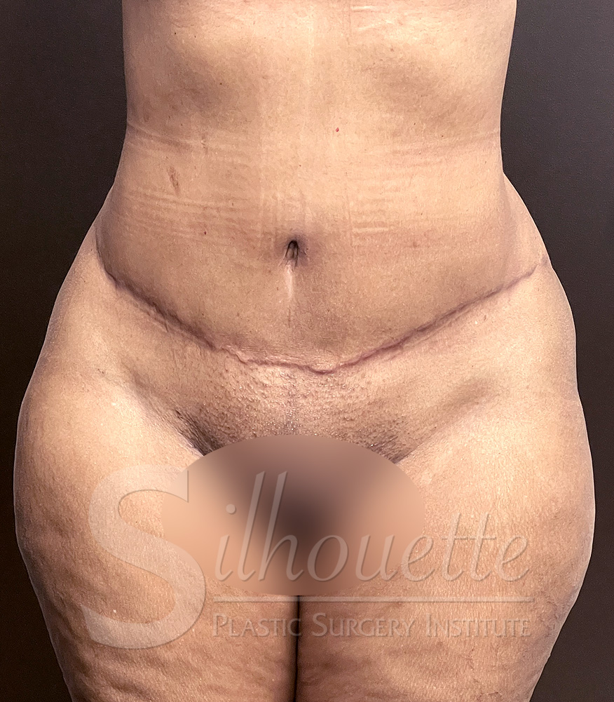 Tummy Tuck before and after - after