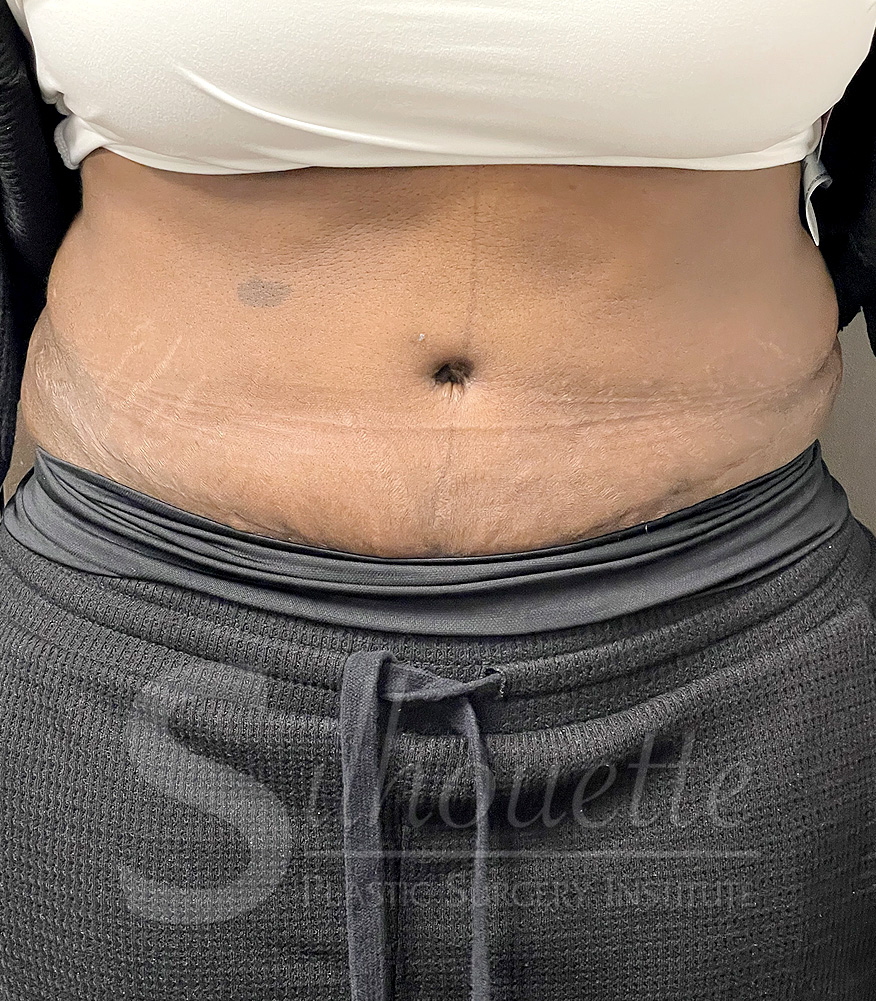 Tummy Tuck before and after - after