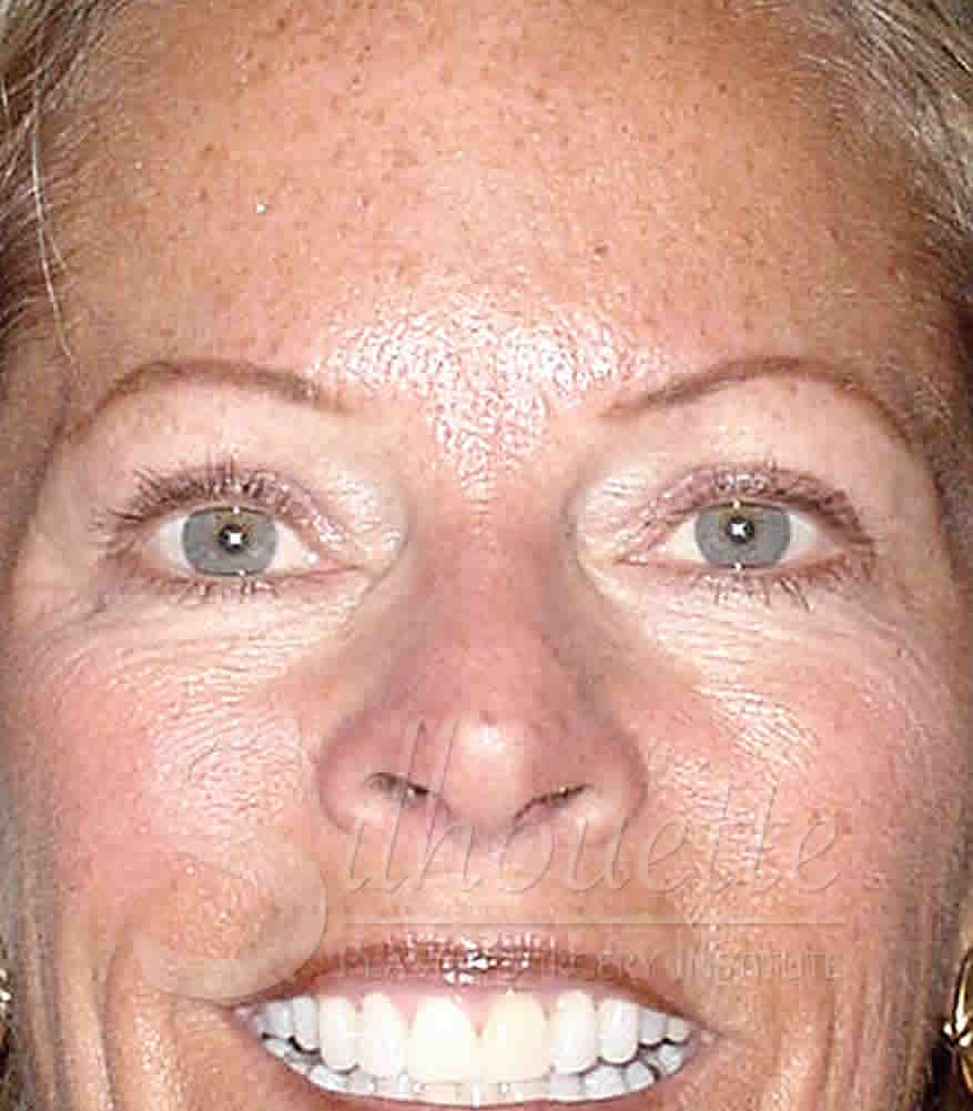 Procedure before and after - after