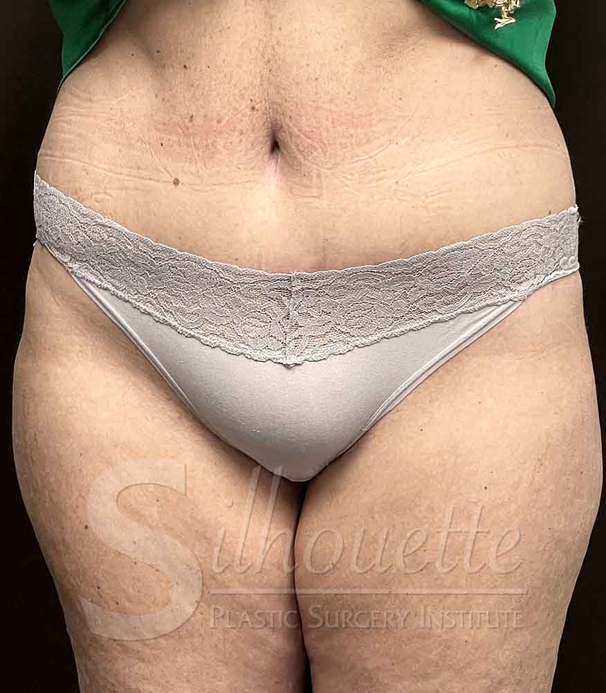Tummy Tuck before and after - after