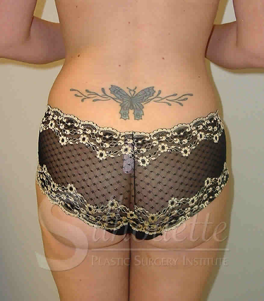 Liposuction before and after - after
