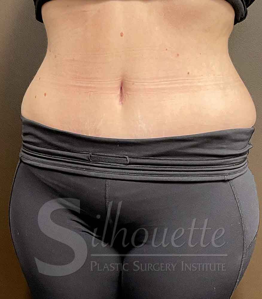 Tummy Tuck before and after - after