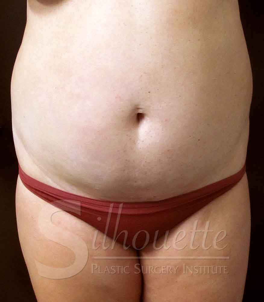 Tummy Tuck before and after - before