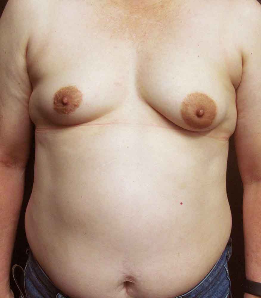 Breast Augmentation before and after - before