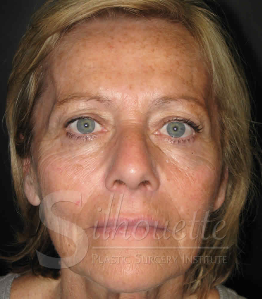 Procedure before and after - before