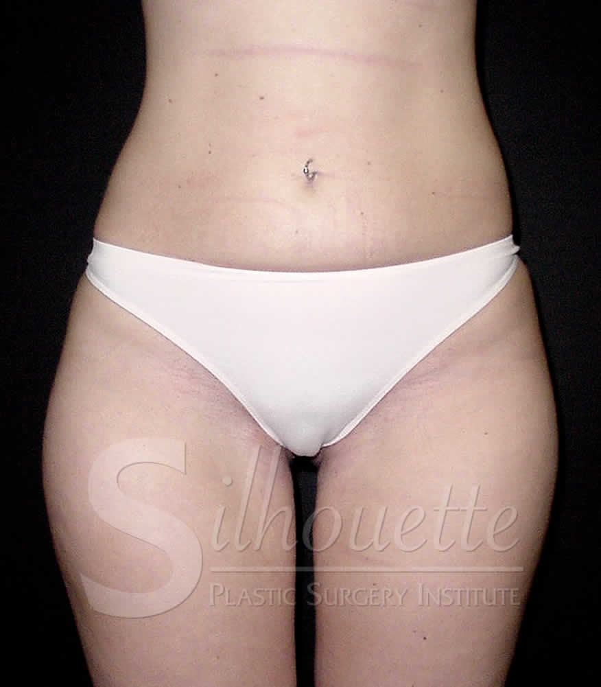 Liposuction before and after - before