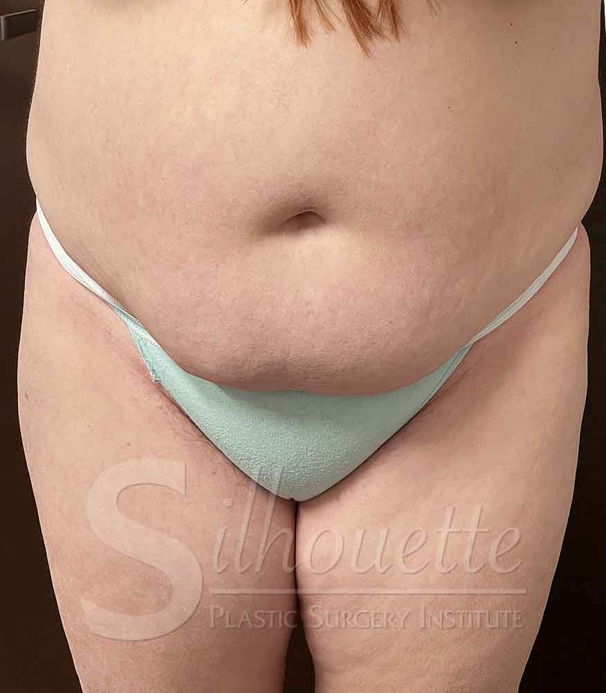 Tummy Tuck before and after - before