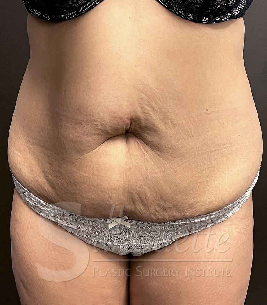 Tummy Tuck before and after - before