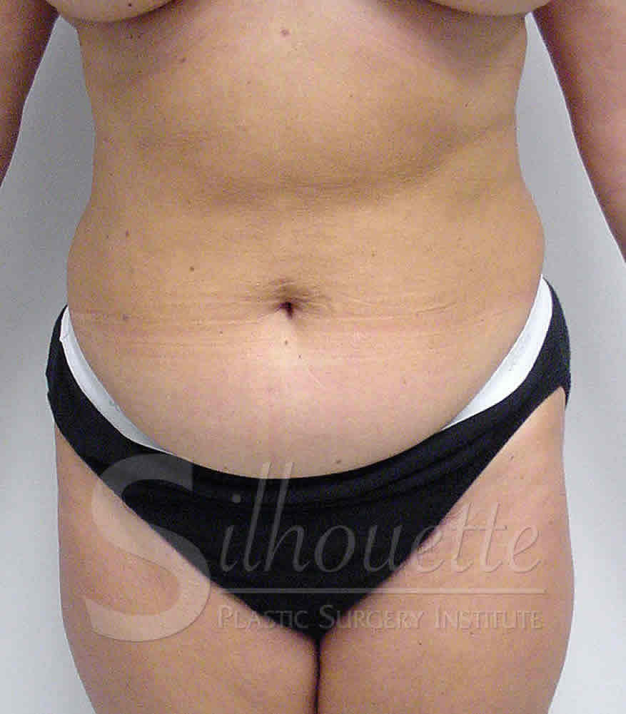 Liposuction before and after - before
