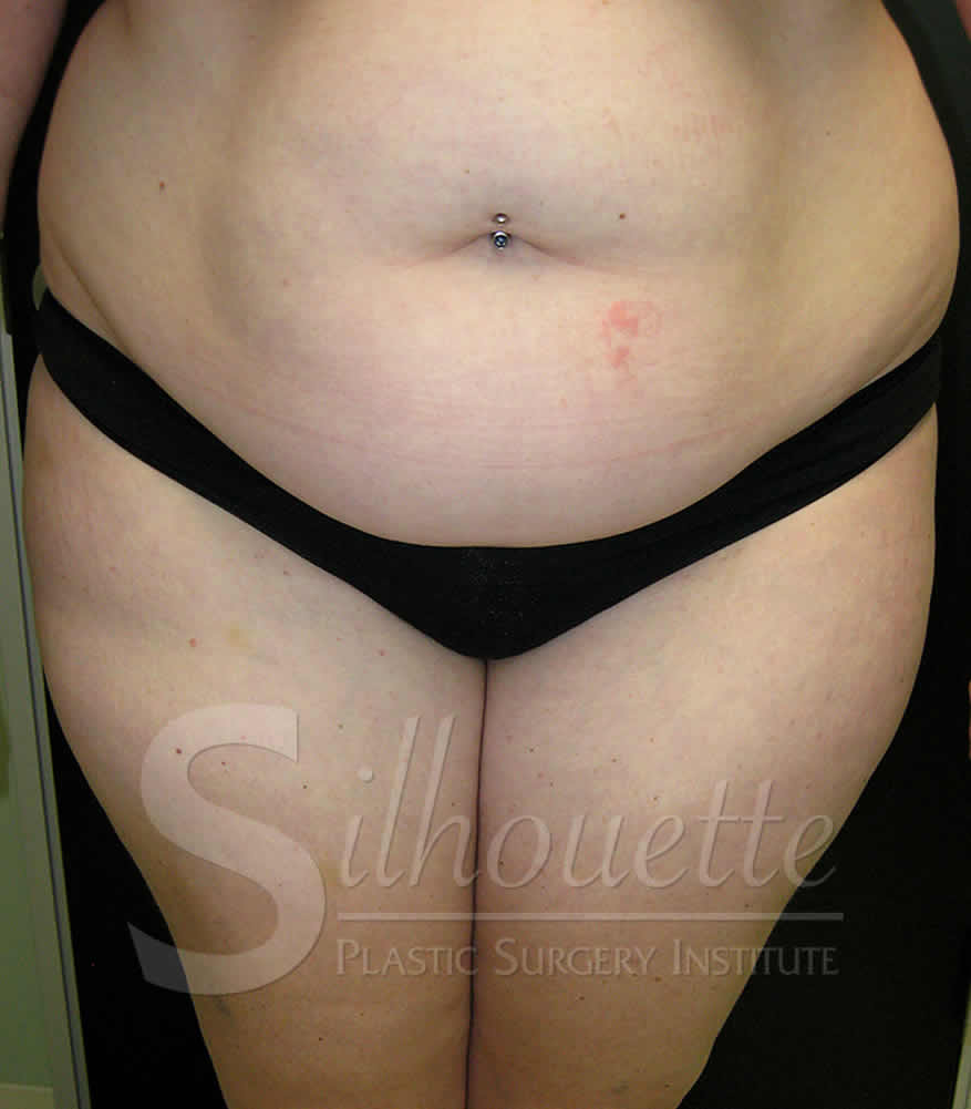 Procedure before and after - before