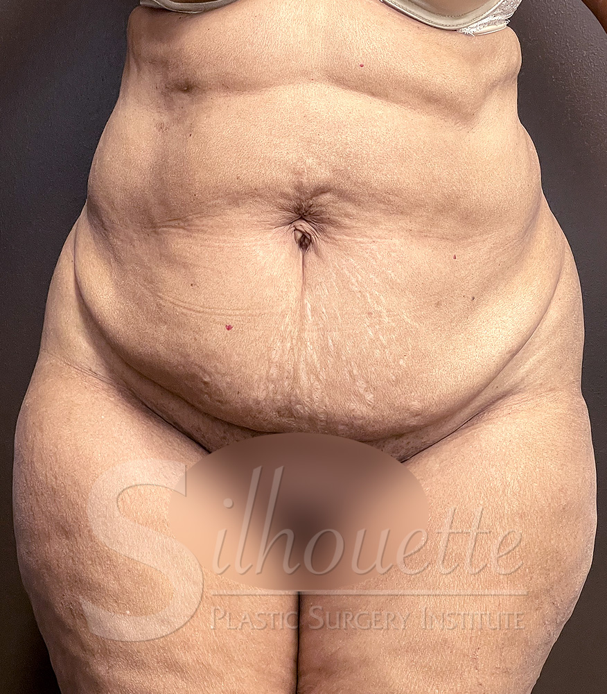 Tummy Tuck before and after - before