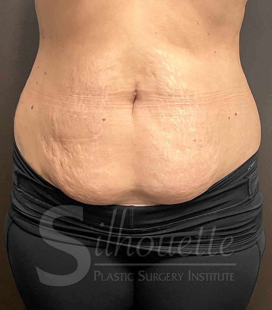 Tummy Tuck before and after - before