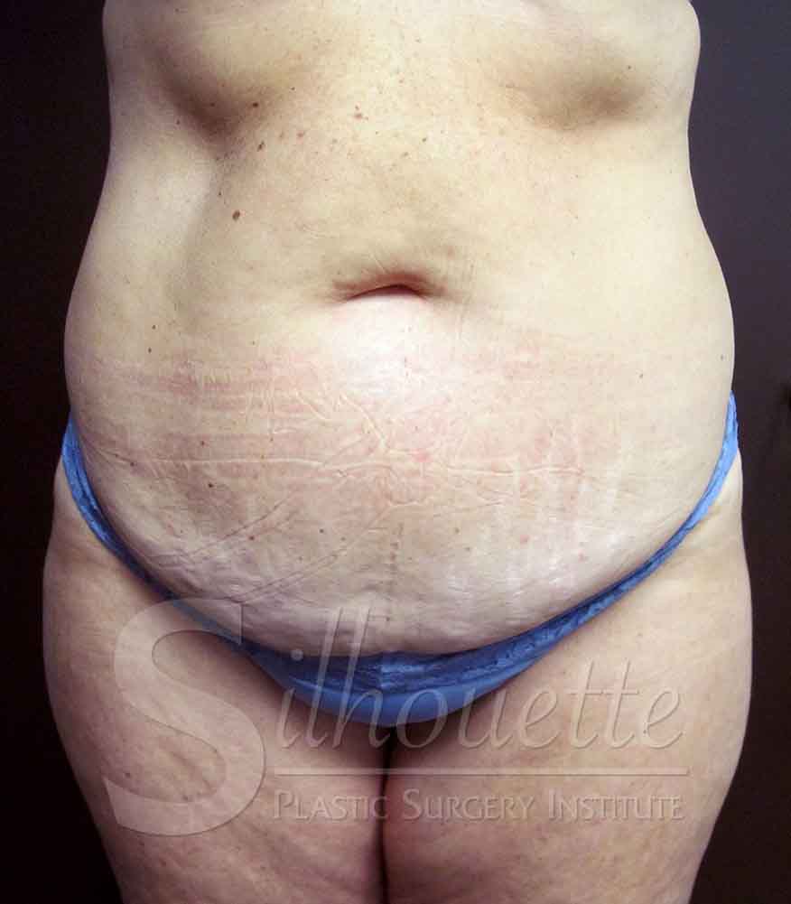 Tummy Tuck before and after - before