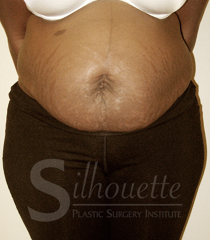 Tummy Tuck before and after - before