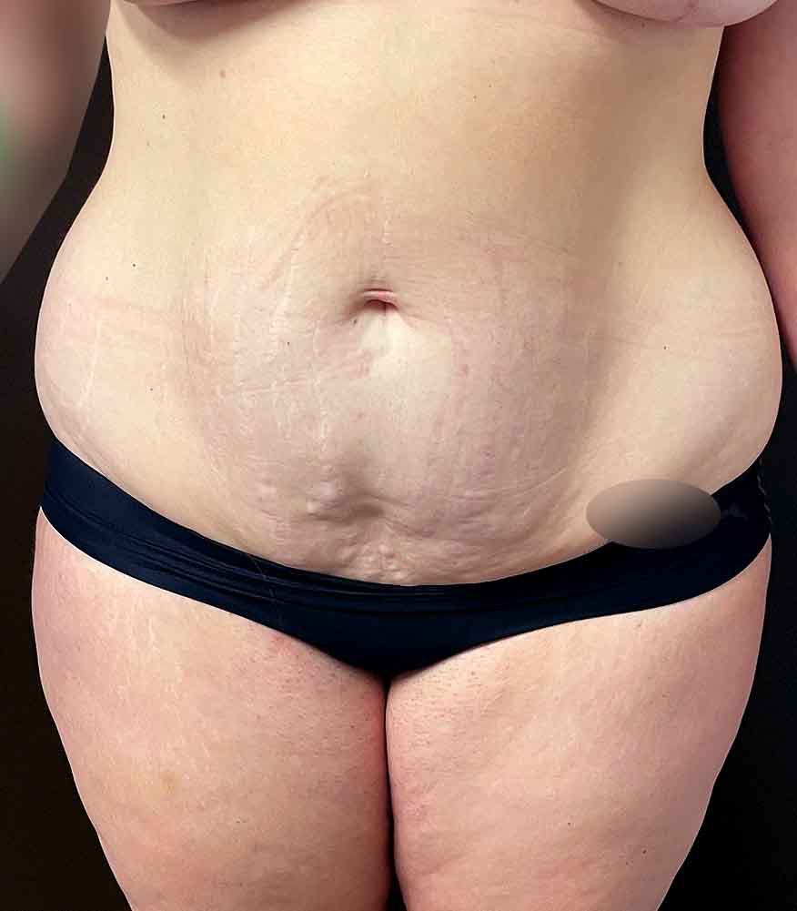 Tummy Tuck before and after - before