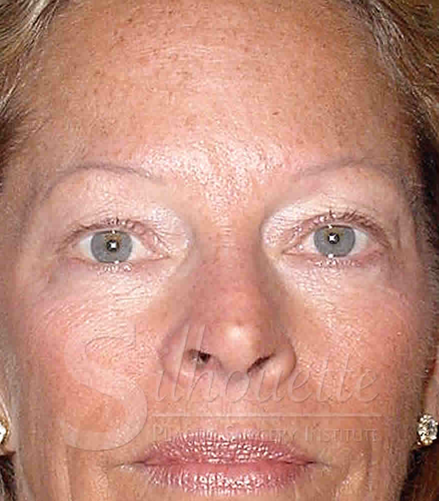 Procedure before and after - before