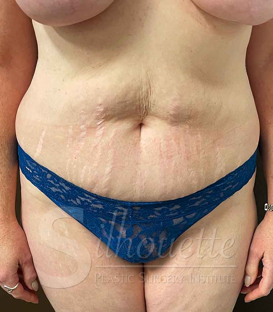 Tummy Tuck before and after - before