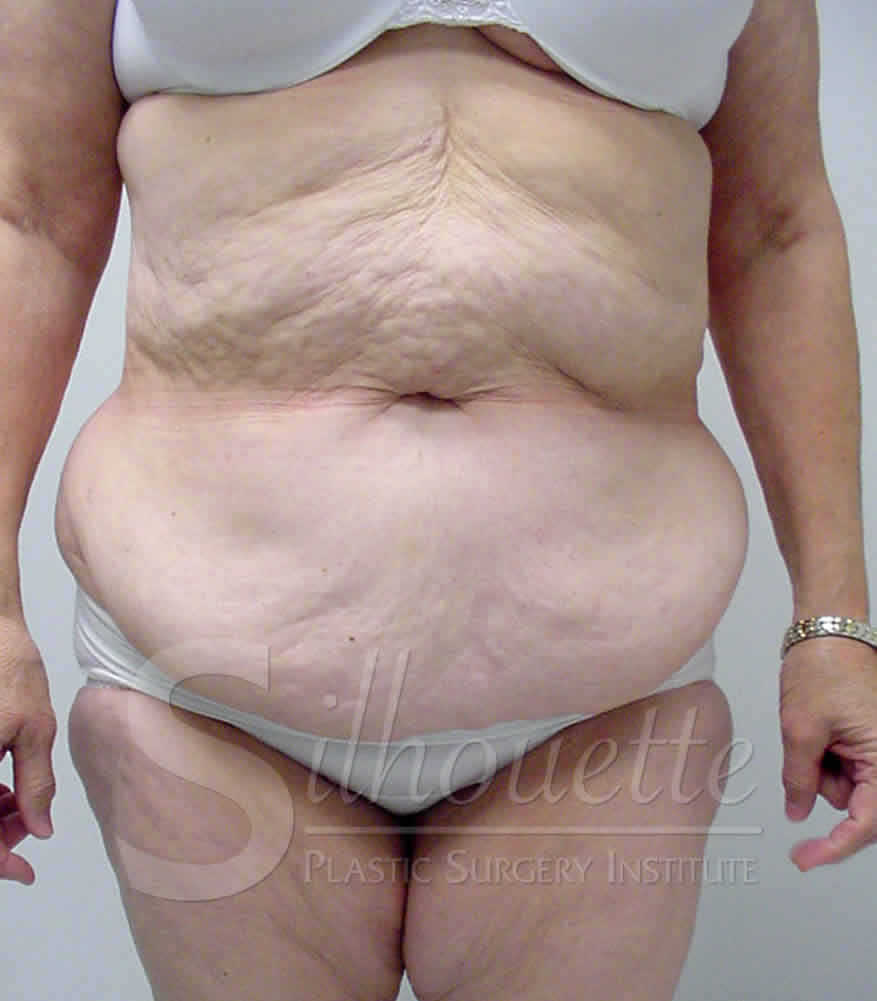 Procedure before and after - before