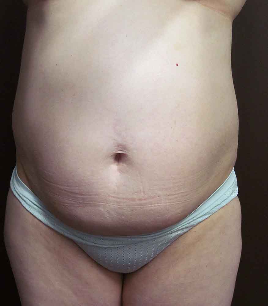 Tummy Tuck before and after - before