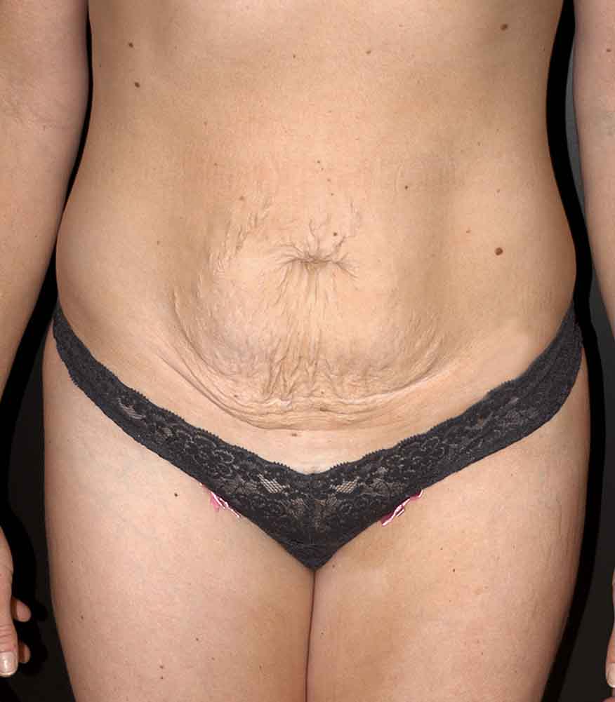 Tummy Tuck before and after - before