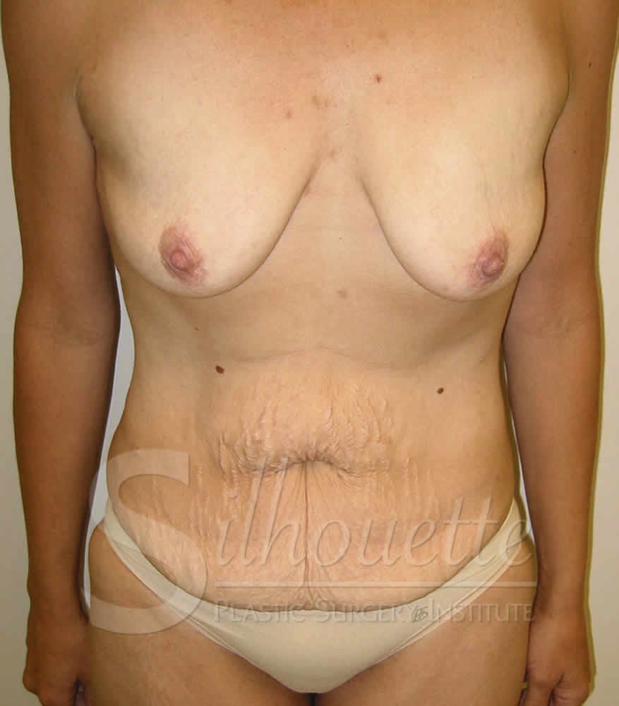 Procedure before and after - before