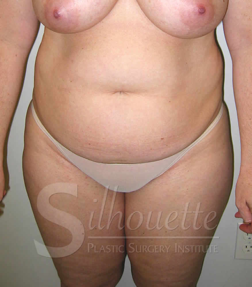 Liposuction before and after - before