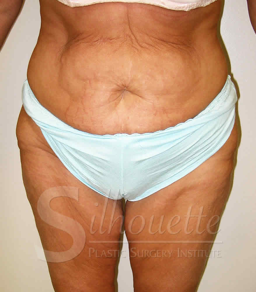 Procedure before and after - before