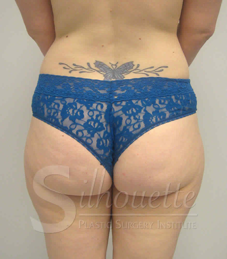 Liposuction before and after - before