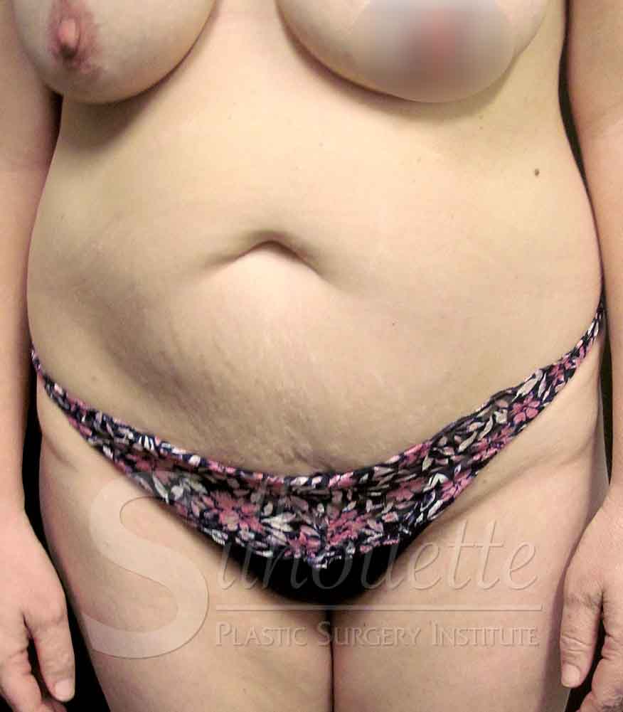 Tummy Tuck before and after - before