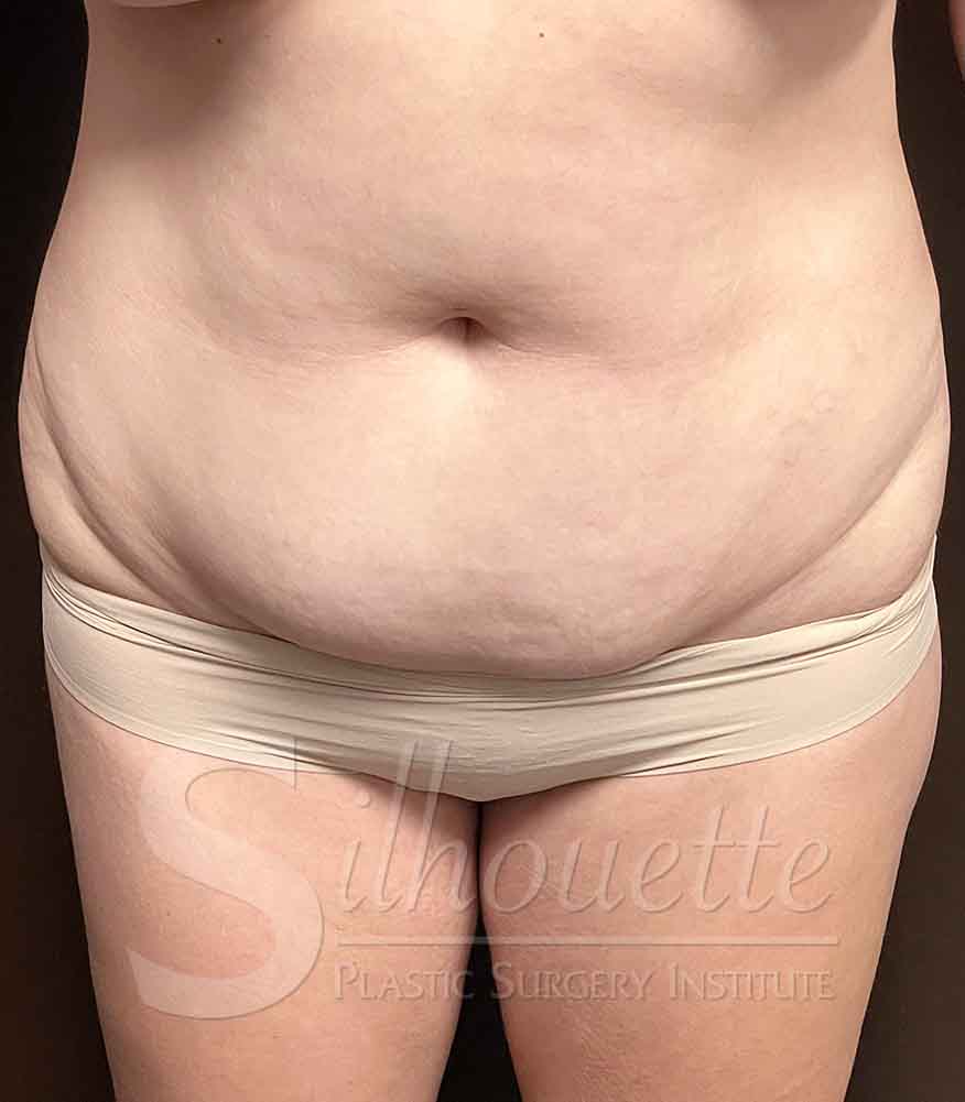 Tummy Tuck before and after - before